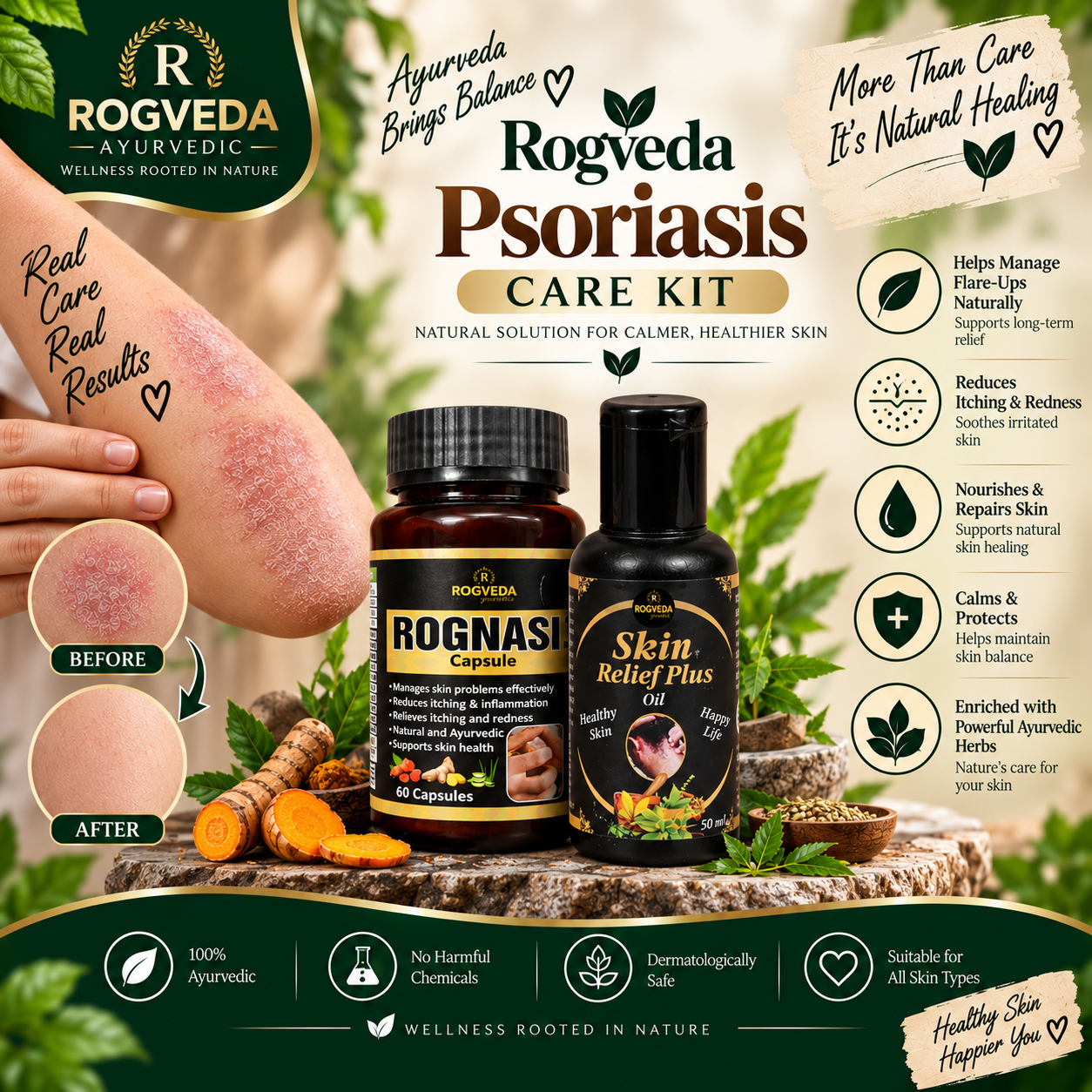 Rogveda Psoriasis Care Kit - Image 3